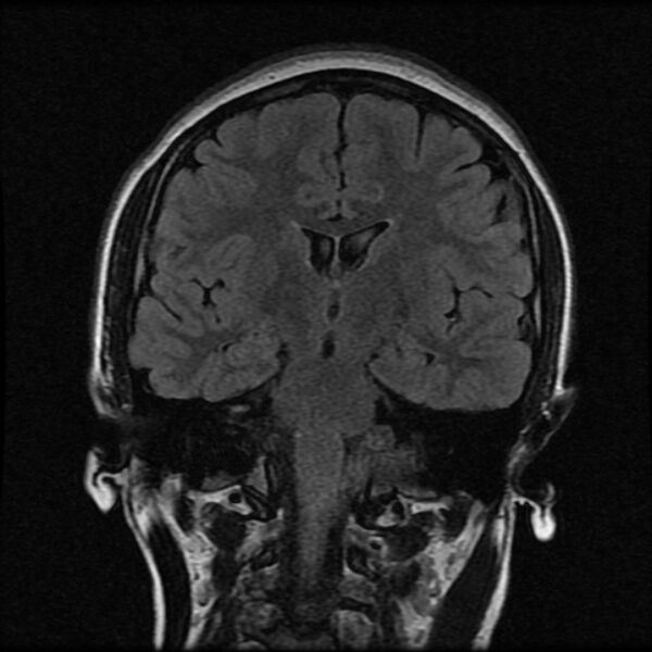File:Cerebral cavernous malformation (Radiopaedia 44301-47942 Coronal FLAIR 11).jpg