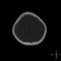 Cerebral contusion (Radiopaedia 48869-53911 Axial bone window 4).jpg