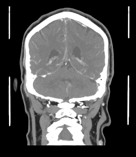 File:Cerebral dural venous sinus thrombosis (Radiopaedia 86514-102576 B 51).jpg