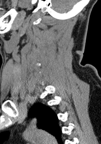 File:Cerebral hemorrhagic contusions and cervical spine fractures (Radiopaedia 32865-33841 G 34).jpg
