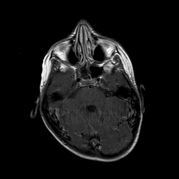File:Cerebral tuberculoma (Radiopaedia 41152-43932 Axial T1 C+ 6).jpg