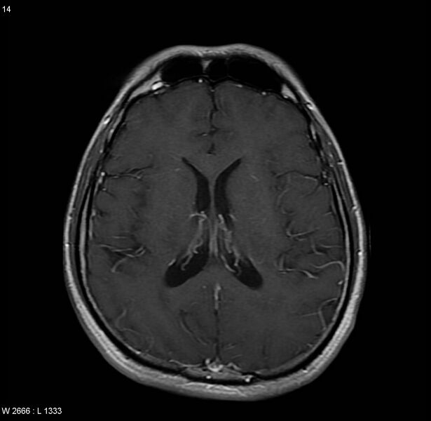File:Cerebral vasculitis (Radiopaedia 5131-6923 Axial T1 C+ 3).jpg