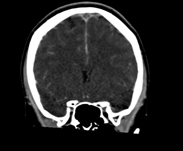 File:Cerebral venous sinus thrombosis (Radiopaedia 59224-66646 Coronal C+ delayed 26).jpg