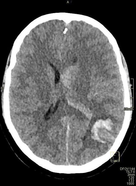 File:Cerebral venous sinus thrombosis (Radiopaedia 91329-108965 Axial non-contrast 29).jpg