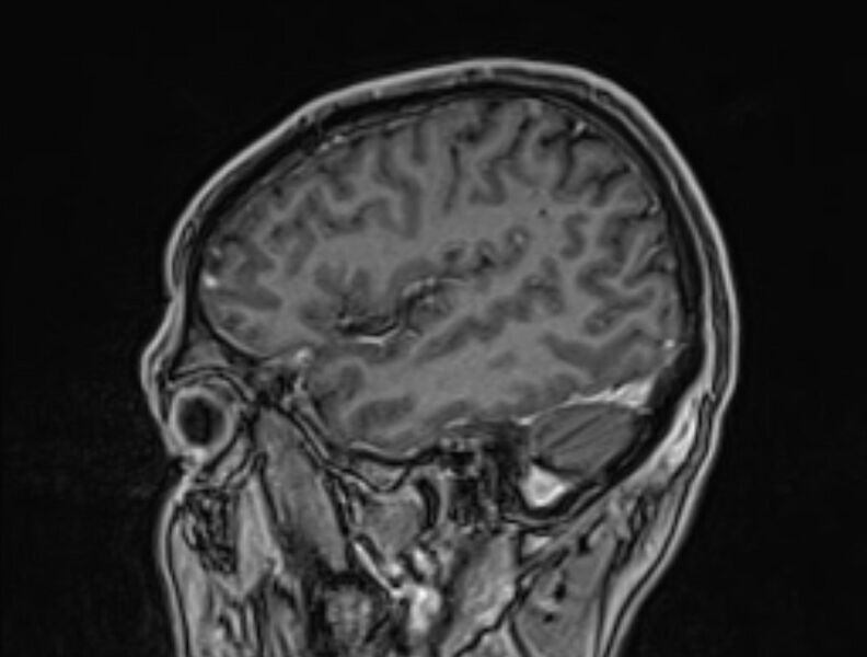 File:Cerebral venous thrombosis (Radiopaedia 71207-81504 Sagittal T1 C+ 51).jpg