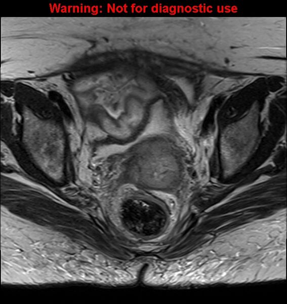 File:Cervical cancer (Radiopaedia 24151-24410 Axial T2 17).jpg