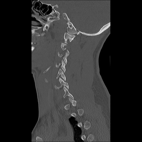 File:Cervical facet fracture and anterior discoligamentous injury (Radiopaedia 32139-33083 Sagittal bone window 30).jpg