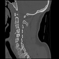 Cervical flexion teardrop fracture with cord hemorrhage (Radiopaedia 32497-33454 Sagittal bone window 18).jpg