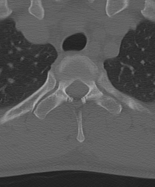 File:Cervical intercalary bone (Radiopaedia 35211-36748 Axial bone window 70).png