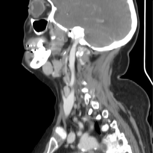 File:Cervical lymphadenopathy- cause unknown (Radiopaedia 22420-22457 D 27).jpg