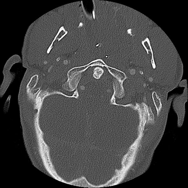 File:Cervical spine fractures with vertebral artery dissection (Radiopaedia 32135-33078 Axial bone window 71).jpg