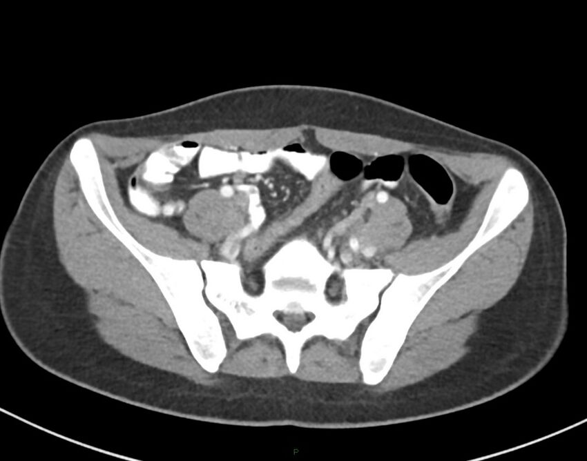 Cesarean scar endometriosis (Radiopaedia 82925-97262 A 63).jpg