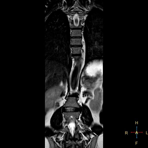 File:Chance fracture of T12 (Radiopaedia 24313-24588 Coronal T2 8).jpg