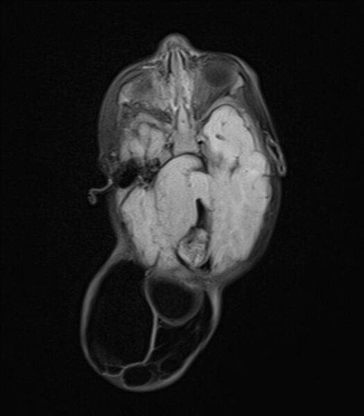 File:Chiari III malformation with occipital encephalocele (Radiopaedia 79446-92559 Axial FLAIR 12).jpg