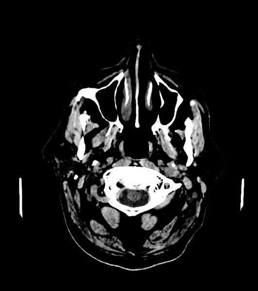 File:Cholangiocarcinoma with cerebral metastases (Radiopaedia 83519-98628 Axial non-contrast 7).jpg