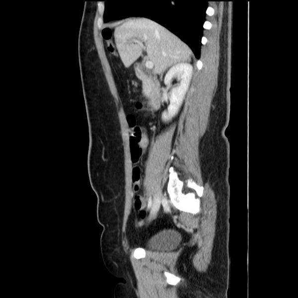 File:Choledocholithiasis on CT and MRI (Radiopaedia 24825-25087 D 25).jpg