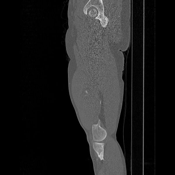 File:Chondrosarcoma arising from exostosis (Radiopaedia 59996-67507 Sagittal bone window 18).jpg
