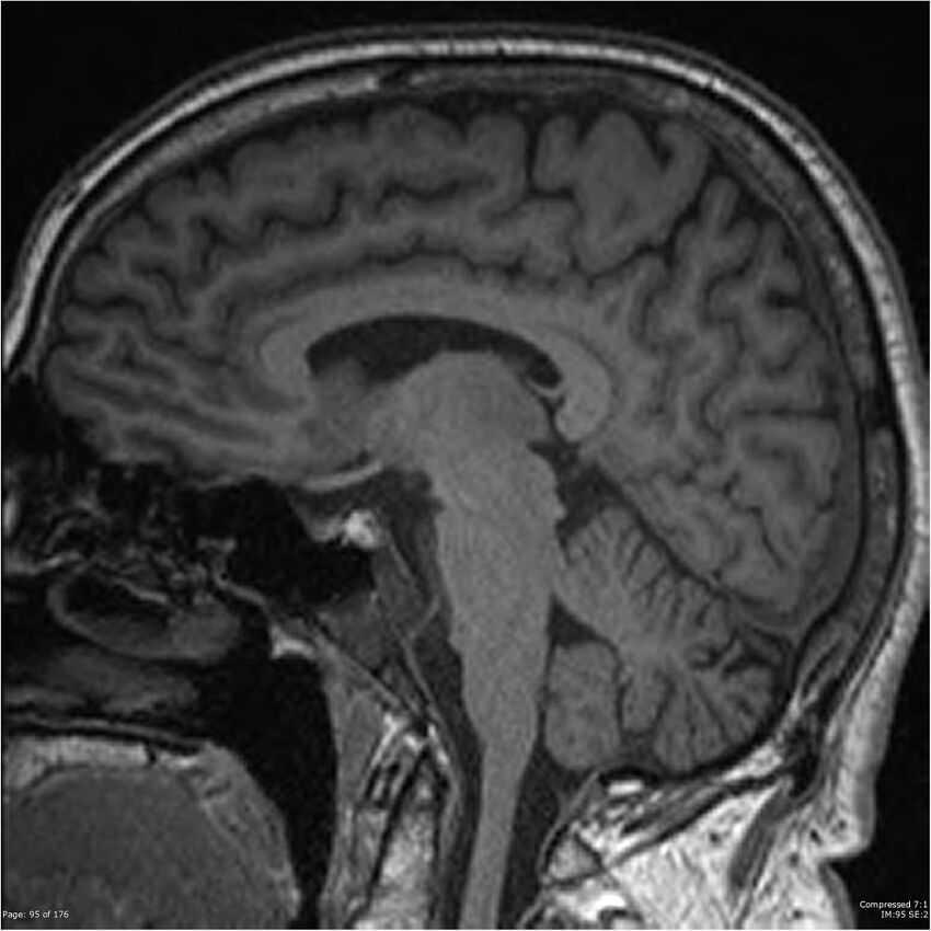 Chondrosarcoma of skull base- grade II (Radiopaedia 40948-43654 Sagittal T1 18).jpg
