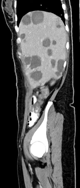 File:Choriocarcinoma liver metastases (Radiopaedia 74768-85766 C 138).jpg