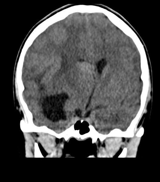 File:Choroid plexus carcinoma (Radiopaedia 91013-108552 Coronal non-contrast 38).jpg