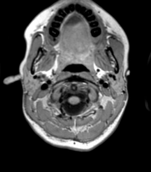 File:Choroid plexus carcinoma (Radiopaedia 91013-108553 Axial T1 22).jpg