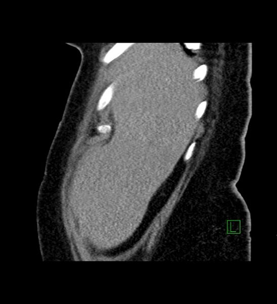 File:Chromophobe renal cell carcinoma (Radiopaedia 84239-99519 D 102).jpg