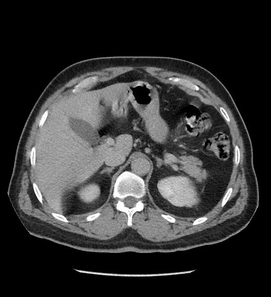 File:Chromophobe renal cell carcinoma (Radiopaedia 86879-103083 D 34).jpg