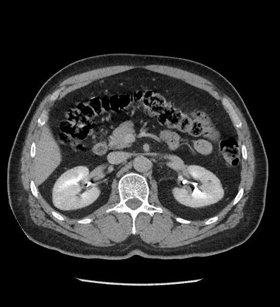 File:Chromophobe renal cell carcinoma (Radiopaedia 86879-103083 D 52).jpg
