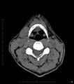 Chronic Submandibular sialolithiasis (Radiopaedia 16880-16606 Axial non-contrast 22).jpg