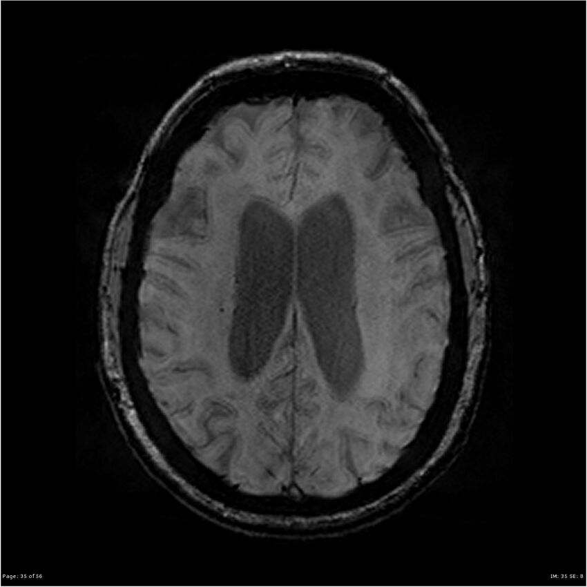 Chronic hypertensive encephalopathy (Radiopaedia 25764-25918 Axial SWI 35).jpg