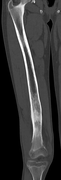 File:Chronic ostemyelitis of the femur with long sinus tract (Radiopaedia 74947-85982 Coronal bone window 40).jpg