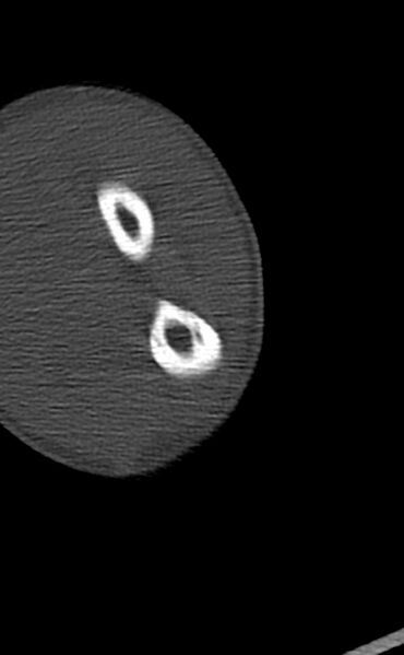 File:Chronic osteomyelitis of the distal humerus (Radiopaedia 78351-90971 Axial 96).jpg