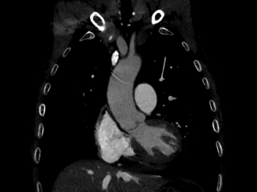 Chronic pulmonary embolism (Radiopaedia 91241-108843 A 33).jpg