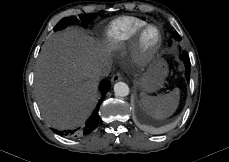 File:Chronic pulmonary embolism with bubbly consolidation (Radiopaedia 91248-108850 C+ arterial phase 126).jpg