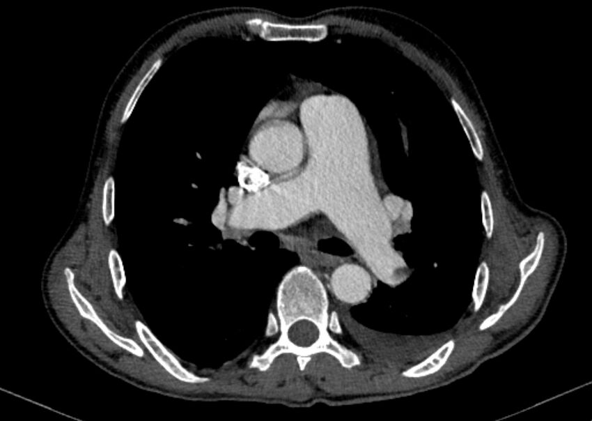 Chronic pulmonary embolism with bubbly consolidation (Radiopaedia 91248-108850 C+ arterial phase 70).jpg