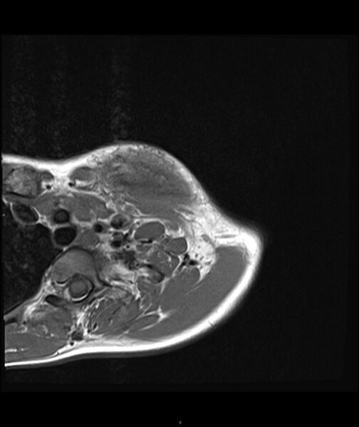 File:Chronic reactive multifocal osteomyelitis (CRMO) - clavicle (Radiopaedia 56406-63071 Axial T1 6).jpg