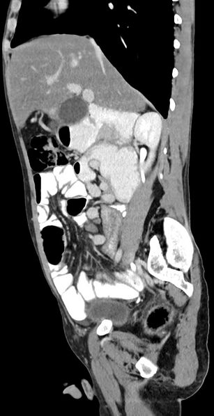 File:Chronic small bowel volvulus (Radiopaedia 75224-86322 C 93).jpg