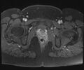 Class II Mullerian duct anomaly- unicornuate uterus with rudimentary horn and non-communicating cavity (Radiopaedia 39441-41755 Axial T1 fat sat 119).jpg