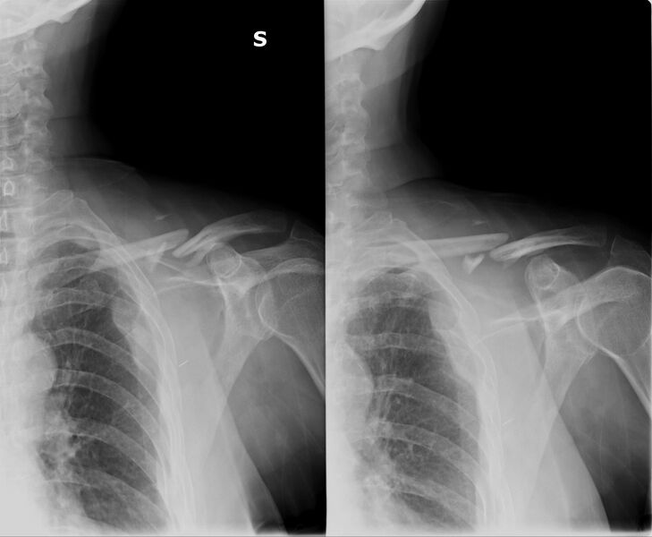 File:Clavicle and rib fractures (Radiopaedia 46123-50477 Frontal 1).jpg
