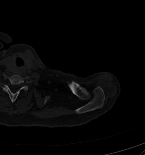 File:Clear cell chondrosarcoma - humerus (Radiopaedia 63104-71612 Axial bone window 10).jpg