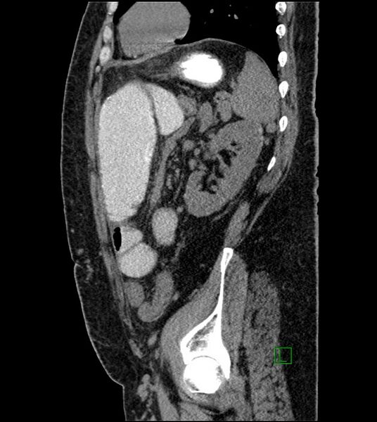 File:Closed-loop small bowel obstruction-internal hernia (Radiopaedia 78439-91096 C 47).jpg