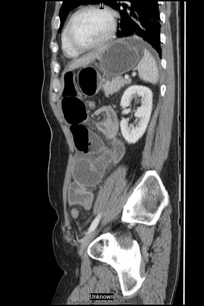 File:Closed loop bowel obstruction and ischemia (Radiopaedia 86959-103180 C 17).jpg