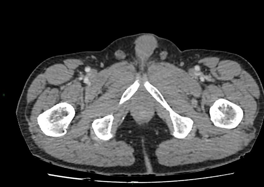 Closed loop small bowel obstruction with ischemia (Radiopaedia 84180-99456 A 128).jpg