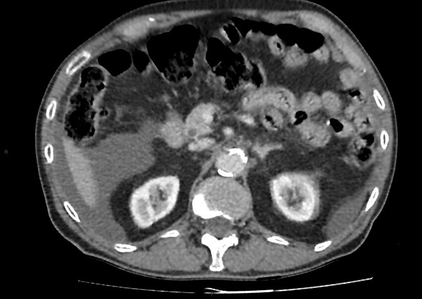 Closed loop small bowel obstruction with ischemia (Radiopaedia 84180-99456 A 37).jpg