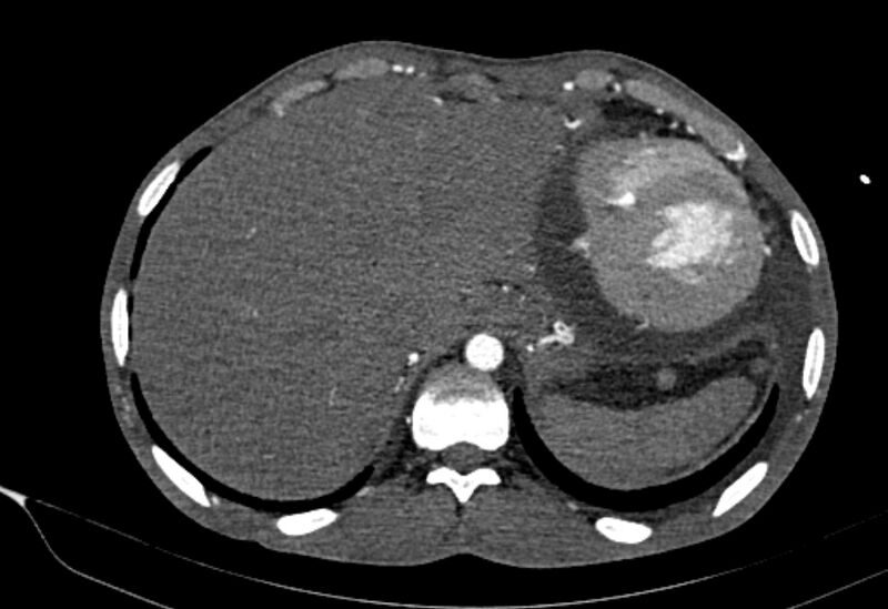 File:Coarctation of aorta with aortic valve stenosis (Radiopaedia 70463-80574 A 210).jpg