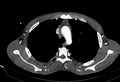 Coarctation of aorta with aortic valve stenosis (Radiopaedia 70463-80574 A 34).jpg
