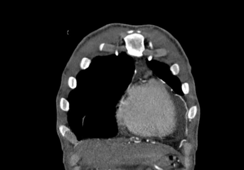 File:Coarctation of aorta with aortic valve stenosis (Radiopaedia 70463-80574 C 11).jpg
