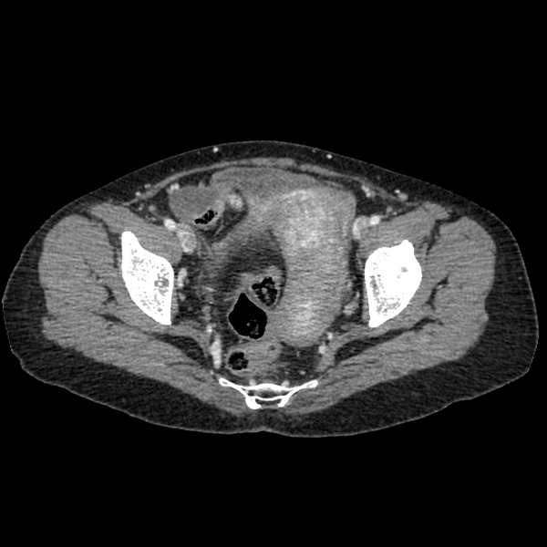 File:Cocoon abdomen with possible tubo-ovarian abscess (Radiopaedia 46235-50636 A 39).png