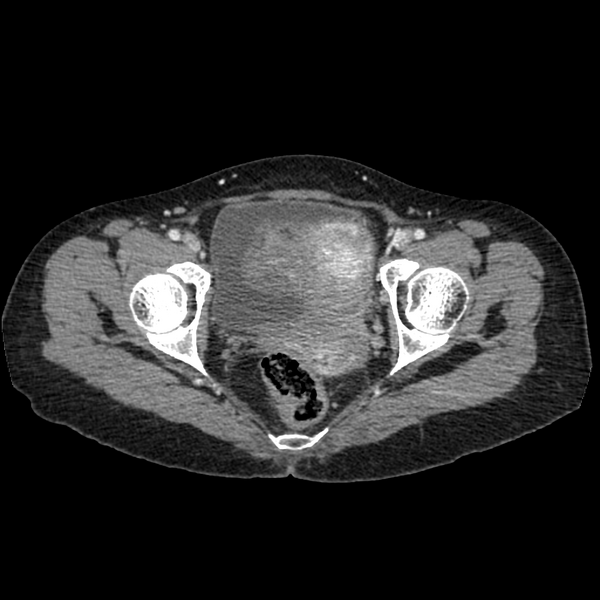 File:Cocoon abdomen with possible tubo-ovarian abscess (Radiopaedia 46235-50636 A 41).png