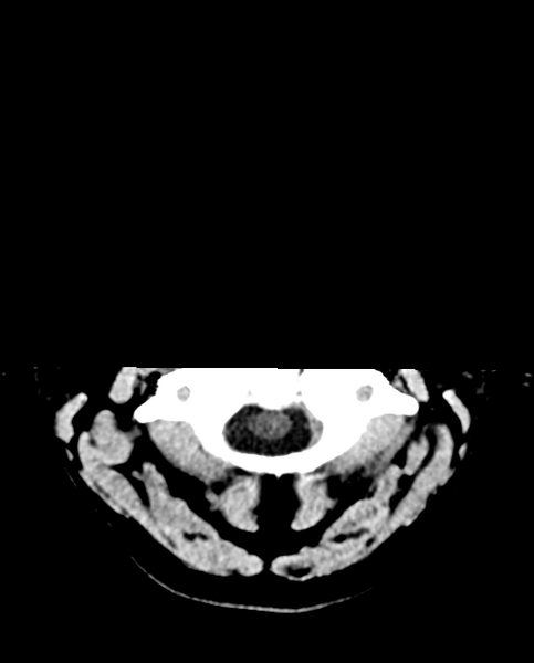 File:Colloid cyst of the third ventricle (Radiopaedia 86571-102661 Axial non-contrast 2).png